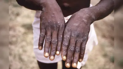 Monkeypox Alert: मंकीपॉक्स को लेकर कानपुर में अलर्ट, हैलट अस्पताल में बना अलग वार्ड बने