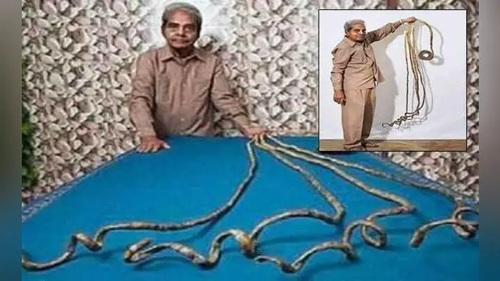 आखिरकार श्रीधर चिल्लाल ने काटा नाखून, लेकिन अब हाथ हुआ बेजान क्योंकि…