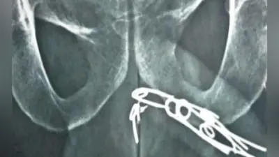 डॉक्टरों ने सर्जरी कर मरीज की मूत्रनली से निकाली आलपीन