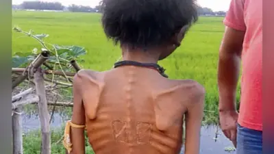 पूर्णिया : कुपोषित के इलाज को मांगे 500 रुपये
