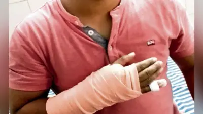 पटना : पीएमसीएच में हड़ताल खत्म, इधर फिर मारपीट, डॉक्टर के हाथ की टूटी अंगुली