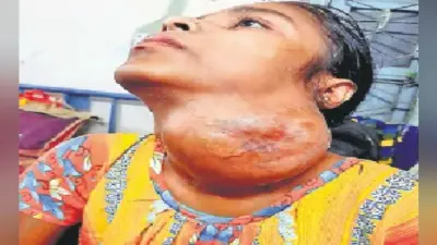 गले से निकाला एक किलो का ट्यूमर