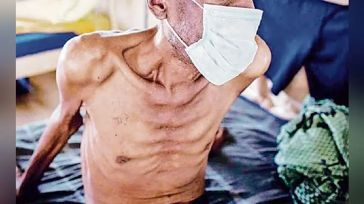 पटना : 14 जिलों के प्राइवेट अस्पतालों में ढूंढ़े जायेंगे 80 हजार टीबी मरीज