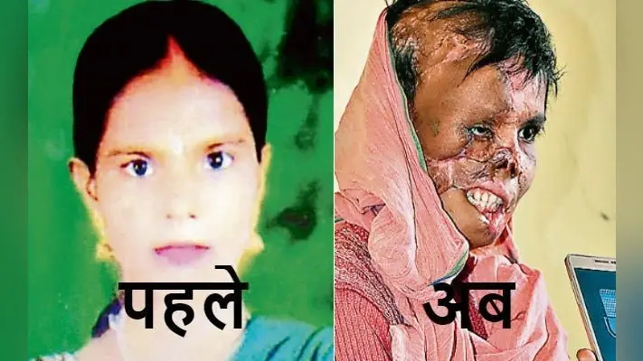 बेटा नहीं हुआ, तो पति ने चेहरे पर फेंक दिया तेजाब, दर्द भरी दास्तां सुनाते हुए रो पड़ीं पलामू निवासी रिंकू देवी
