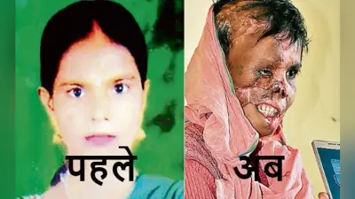 बेटा नहीं हुआ, तो पति ने चेहरे पर फेंक दिया तेजाब, दर्द भरी दास्तां सुनाते हुए रो पड़ीं पलामू निवासी रिंकू देवी
