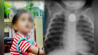 मासूम के गले में अटका था सिक्का, इलाज को बिलखता रहा परिवार
