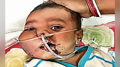 रांची : चार माह के बच्चे के चेहरे पर था ट्यूमर, हुई सफल सर्जरी