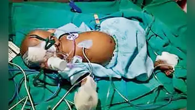 रांची : दो माह के बच्चे की आंखों का हुआ सफल ऑपरेशन