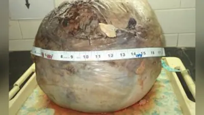 OMG! डॉक्टरों ने महिला की बच्चेदानी से निकाला फुटबॉल जितना बड़ा 18 किलो का ट्यूमर
