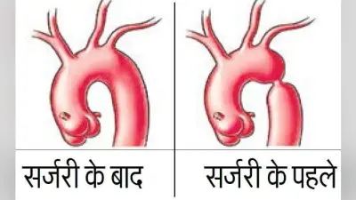 रिम्स : बिना चीरा ठीक हुआ महाधमनी का सिकुड़न