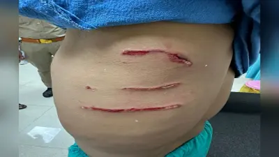 अलीगढ़: एएमयू में अब पीएचडी स्कॉलर पर आवारा कुत्तों ने किया हमला, घायल छात्र सदमें में