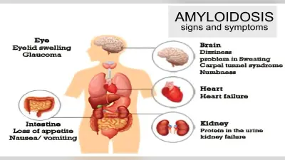 Amyloidosis से जूझ रहे हैं पाकिस्तान के पूर्व राष्ट्रपति जनरल परवेज मुशर्रफ, जानिए इसके बारे में