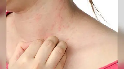 World Psoriasis Day: फास्टफूड खाने से होता है सोरायसिस? किशोरों और युवाओं में ज्यादा फैलती है ये बीमारी