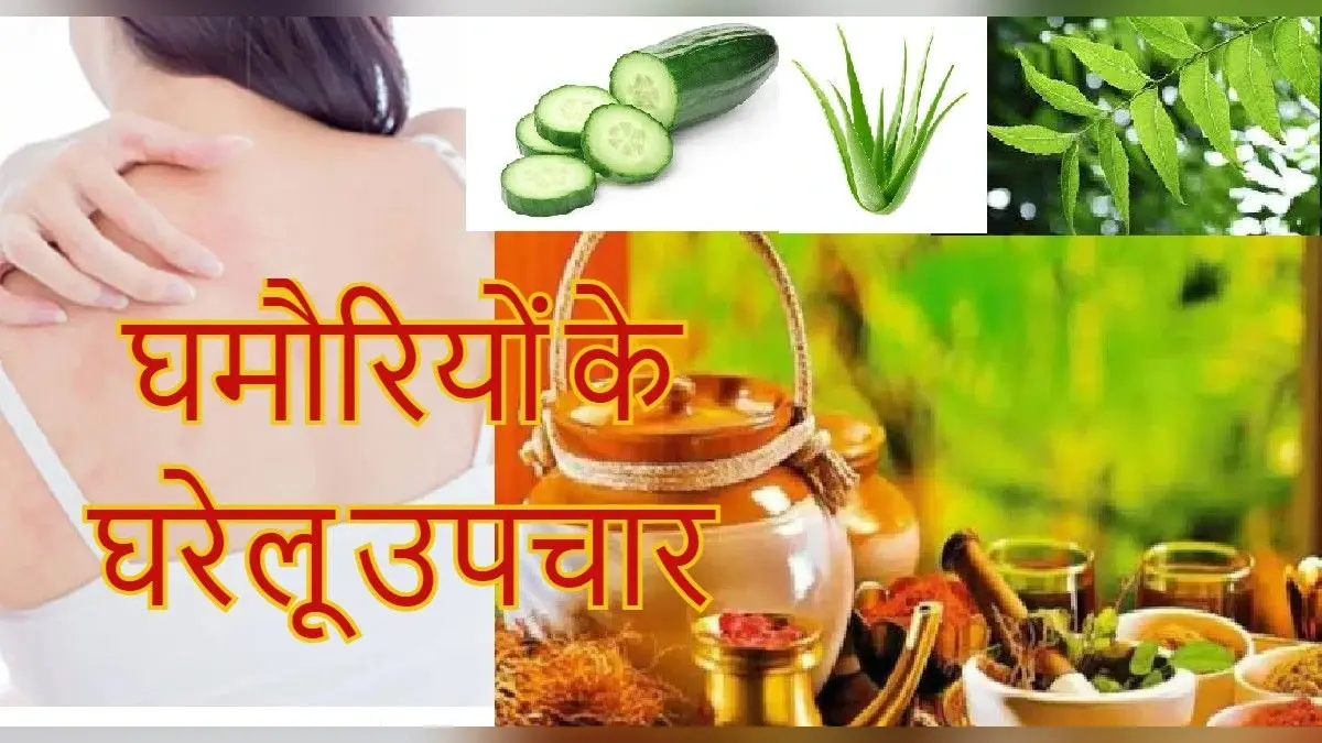 Home Remedies For Prickly Heat: गर्मियों में घमौरियां से परेशान हैं? अपनाएं ये घरेलू उपाय