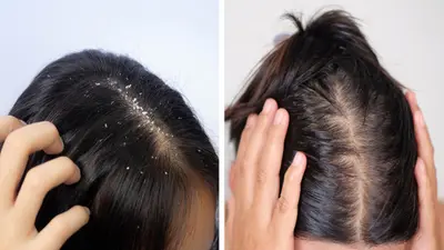 Home remedies for Dandruff: बालों से डैंड्रफ हटाने के 4 आसान घरेलू नुस्खे, जरूर करें ट्राई