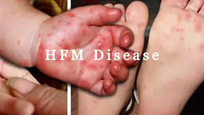 क्या है HFM? बच्चों में दिखाई दे ये लक्षण तो हो जाएं सावधान