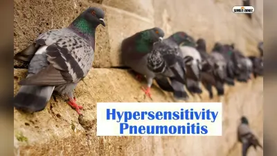 Hypersensitive Pneumonia: कबूतर पालने के हैं शौकीन तो हो जाएं सावधान, हो सकती है ये गंभीर बीमारी