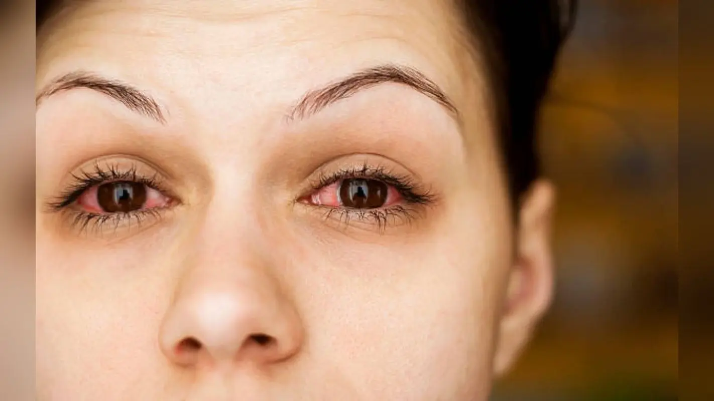 Conjunctivitis: क्या है आंख आना ? मानसून में हर गली में दिख रहे कंजंक्टिवाइटिस के मरीज, जानिए लक्षण और बचाव