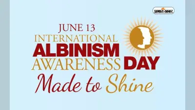 International Albinism Awareness Day 2023: अंतरराष्ट्रीय रंजकहीनता जागरूकता दिवस आज, जानें इसके बारे में