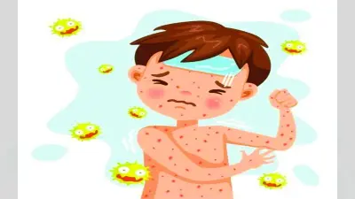 देशभर में खसरा से 14 बच्चों की मौत, 09 झारखंड के, आंकड़ों ने बढ़ायी चिंता