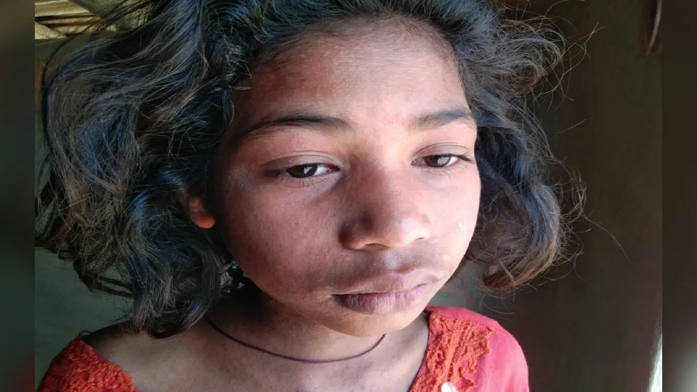 झारखंड: मीजल्स से तेजी से पीड़ित हो रहे बच्चे-बूढ़े, सहमे हैं ग्रामीण