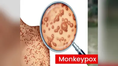 Monkey Pox: देश में पहला केस आया सामने, मंकीपॉक्स के मद्देनज़र दिशानिर्देश जारी, इन लोगों से बचें