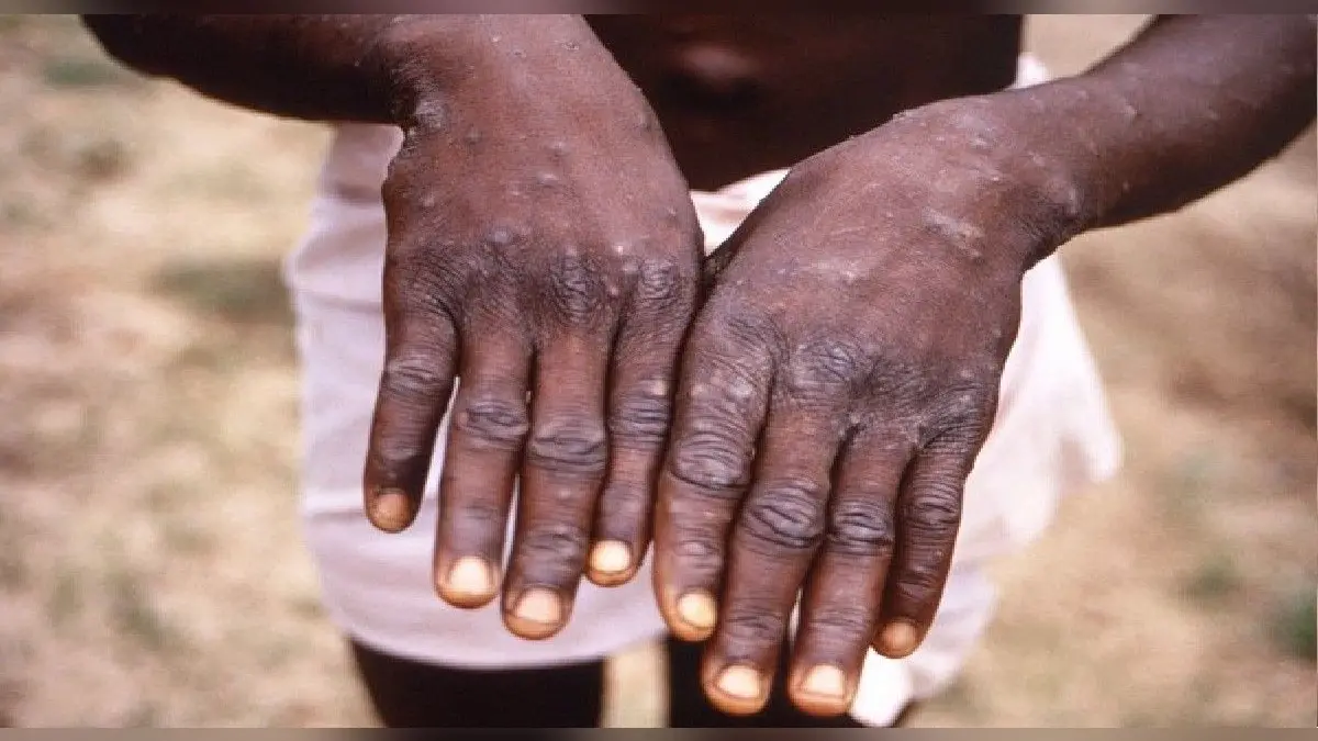 Monkey Pox पर राहत भरी खबर, आंध्र प्रदेश में मरीज की रिपोर्ट आयी निगेटिव, केरल सरकार ने किया ये इंतजाम