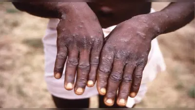 Monkey Pox पर राहत भरी खबर, आंध्र प्रदेश में मरीज की रिपोर्ट आयी निगेटिव, केरल सरकार ने किया ये इंतजाम