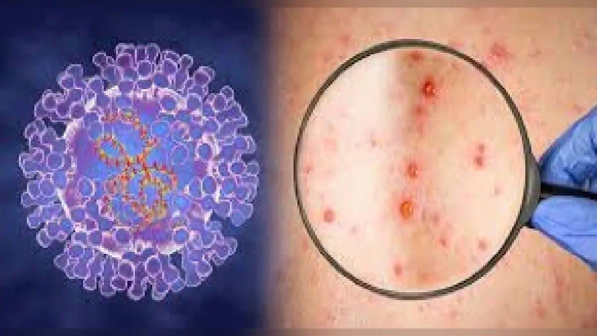 MonkeyPox Bihar: मंकी पॉक्स को लेकर स्वास्थ्य विभाग ने जारी की गाइडलाइन, जानें क्या है बचने के उपाय