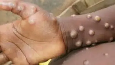 Monkeypox: देश के पहले मंकीपॉक्स मरीज की रिपोर्ट निगेटिव, अस्पताल से डिस्चार्ज
