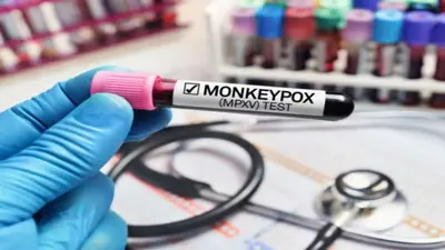 UP News: Mpox से बचाव के लिए उत्तर प्रदेश में तैयारी तेज, लखनऊ के अस्पतालों में आरक्षित किए गए बेड