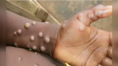 Monkeypox in Delhi: दिल्ली में मिला मंकीपॉक्स का 9वां मरीज, देश में संक्रमितों की संख्या हुई 14