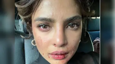 होठों पर खून..चेहरे पर चोट के निशान, प्रियंका चोपड़ा को इस कदर देख फैंस परेशान, पूछा आप ठीक हो…