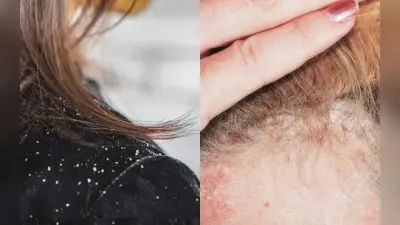 कैसे समझे डैंड्रफ है या स्कैल्प सोरायसिस ? जानिए दोनों का अंतर