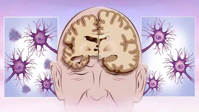 World Alzheimer’s Day: आपके भूलने की आदत कहीं अल्जाइमर का संकेत तो नहीं ! जानें क्या है रोग के लक्षण