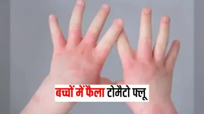 Tomato Flu: छोटे बच्चों को टोमेटो फ्लू का खतरा, कोरोना, मंकीपॉक्स, डेंगू, चिकनगुनिया से नहीं है कोई संबंध