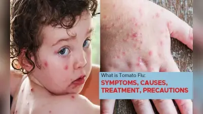 Tomato Flu: क्या है टोमैटो फ्लू, कितनी खतरनाक है ये बीमारी, जानें इसके लक्षण और बचने के उपाय