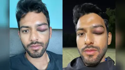 टीम इंडिया के अंडर-19 स्टार उन्मुक्त चंद के आंख पर लगी चोट, सोशल मीडिया पर शेयर की तस्वीर