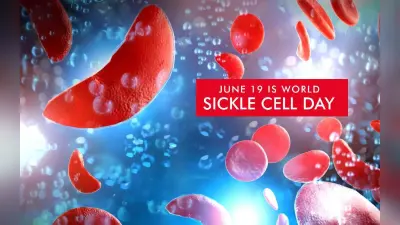 World Sickle Cell Day 2023: वर्ल्ड सिकल सेल अवेयरनेस डे आज, जानें इसके लक्षण और कारण