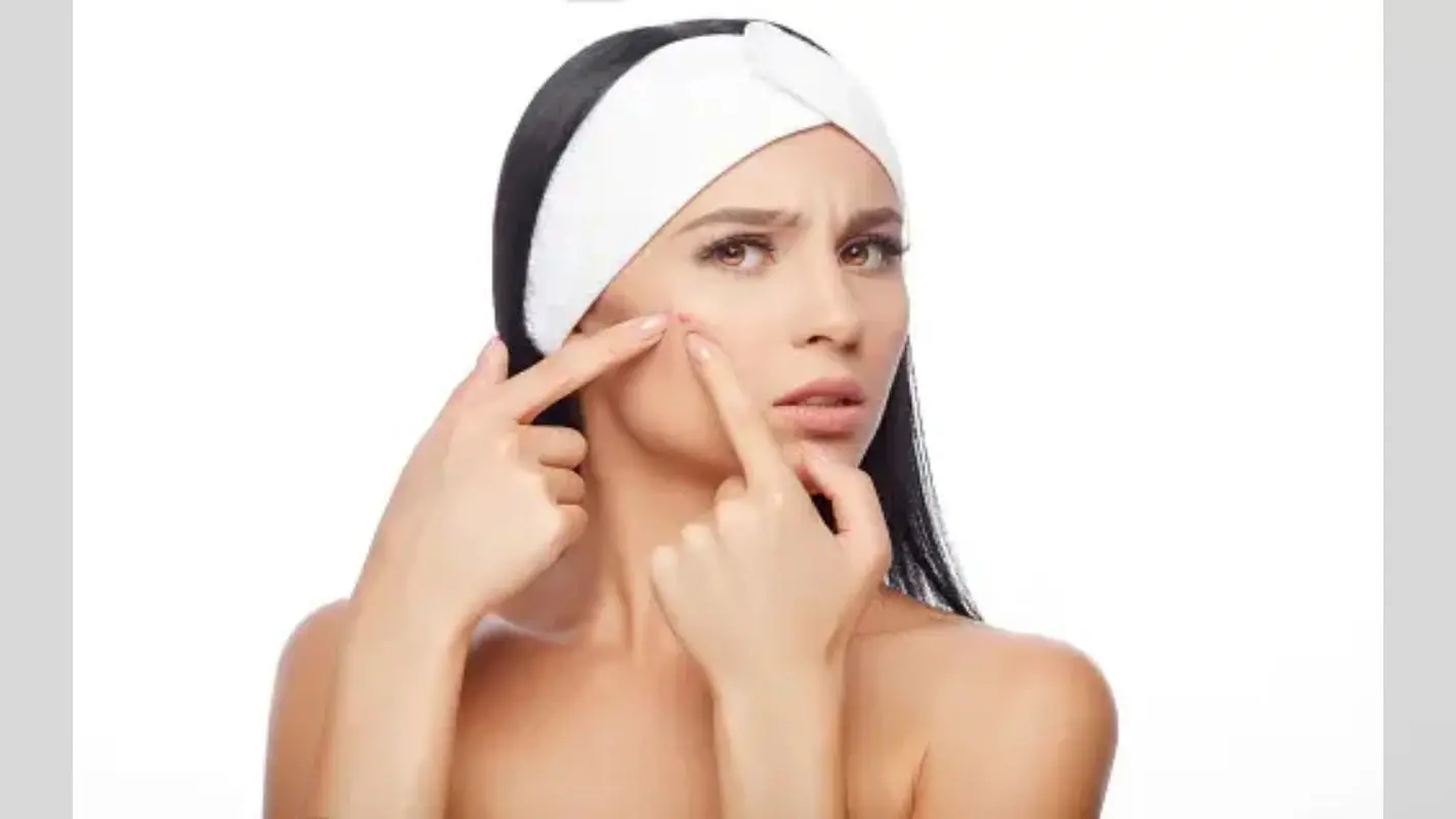 Skin Care Tips: आपकी खूबसूरती पर मुहांसो ने लगा दिया है दाग, आज ही कर लें ये उपाय, तुरंत मिलेगा छुटकारा