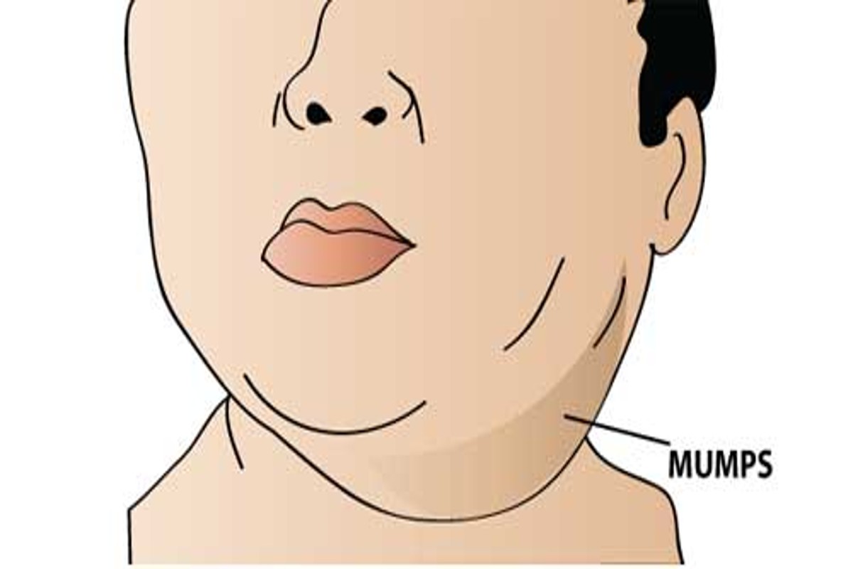 Mumps Symptoms & Treatments: क्या है गलसुआ? शरीर में दिखे ये लक्षण तो तुरंत भागे डॉक्टर के पास