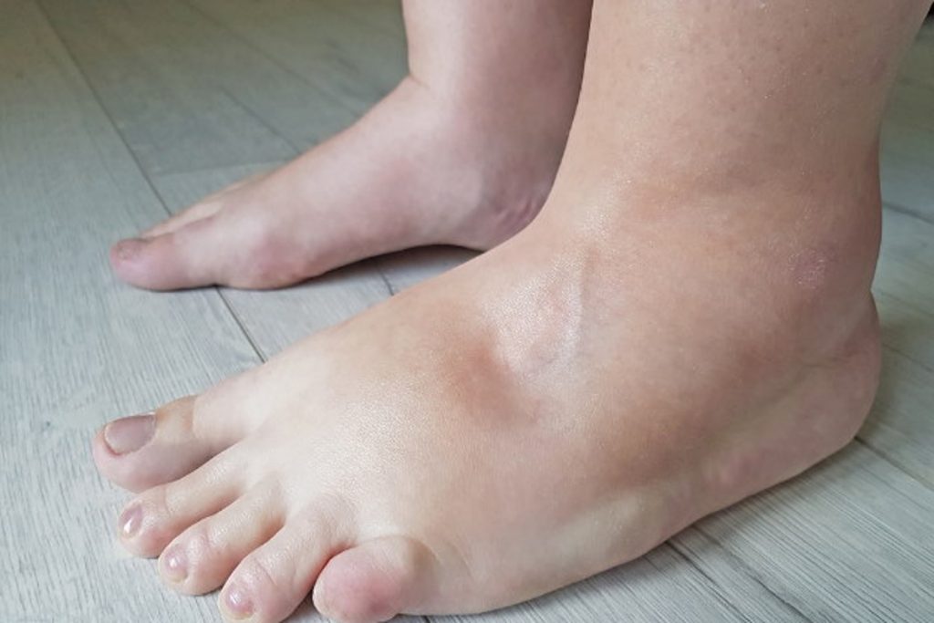 Body Swelling