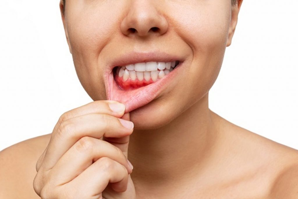 Mouth Cancer
