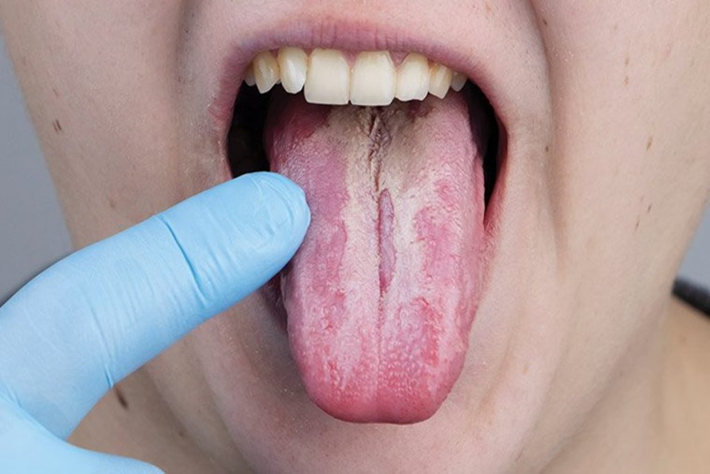 Mouth Cancer
