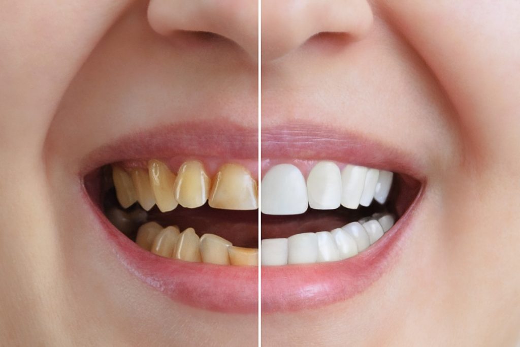 White teeth