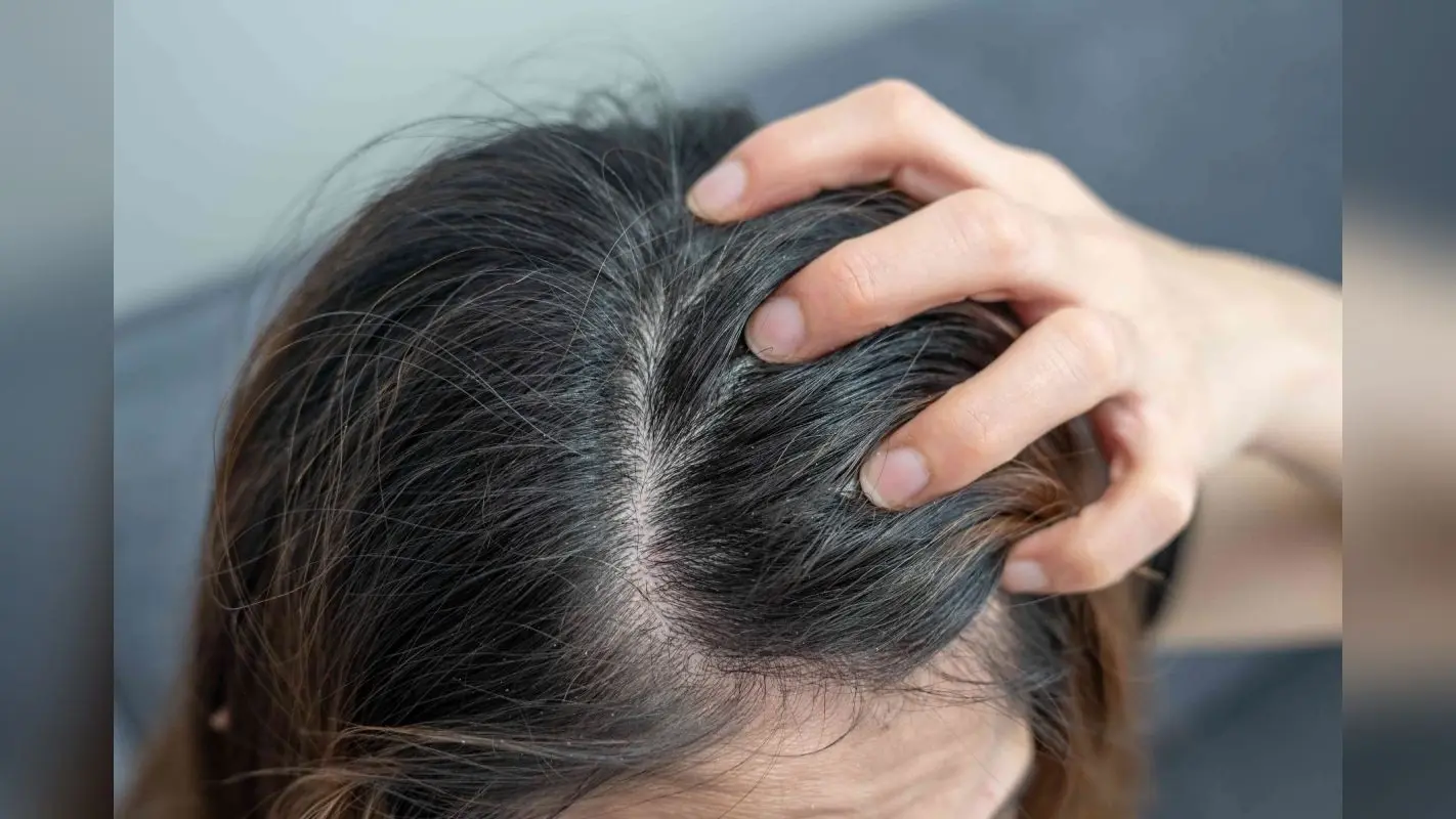 Itchy Scalp Problem: गर्मी के मौसम में बालों में खुजली से हैं परेशान, तो ये हैं आप के लिए कुछ आसान उपाय