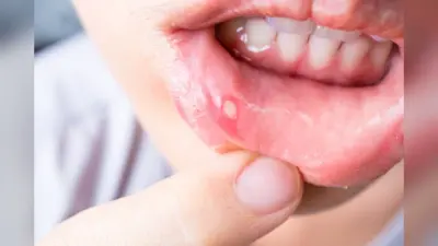 World Oral Health Day 2024: किसी भी उम्र में हो सकता है माउथ कैंसर, जानिए कारण, लक्षण और इलाज