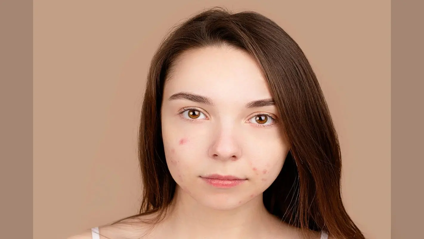 Acne: इस तरह अपने चेहरे से हटाएं मुंहासे के दाग