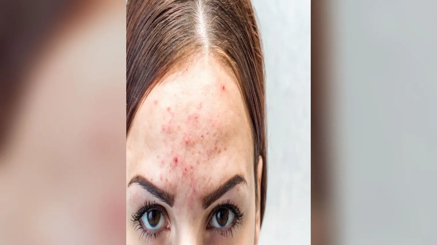 Beauty Tips: फोड़े-फुंसी से छुटकारा पाने के घरेलू नुस्खे: प्राकृतिक उपचार और सावधानियाँ