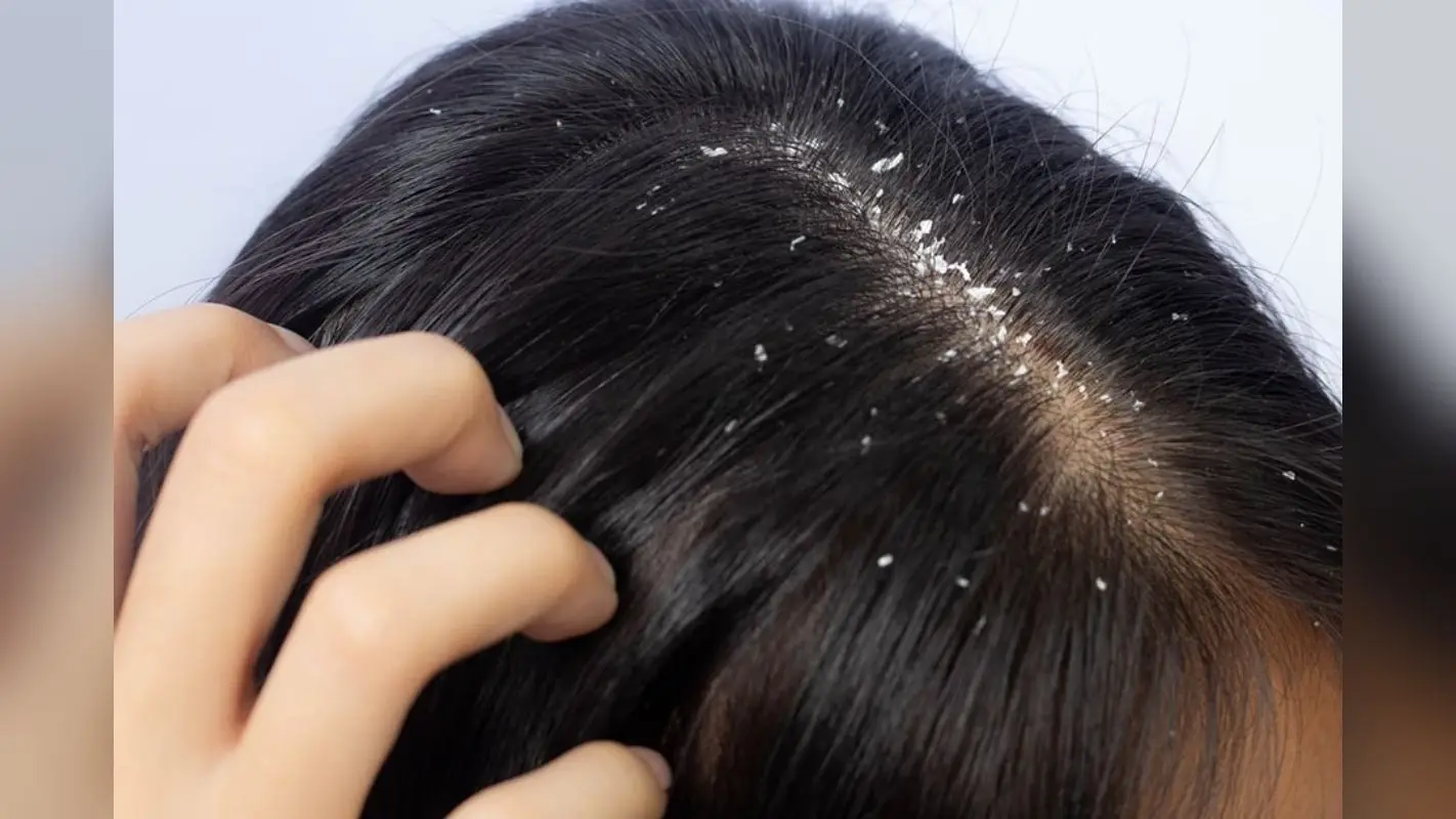 Dandruff remedy: प्राकृतिक तरीके से डैंड्रफ से छुटकारा पाने के उपाय